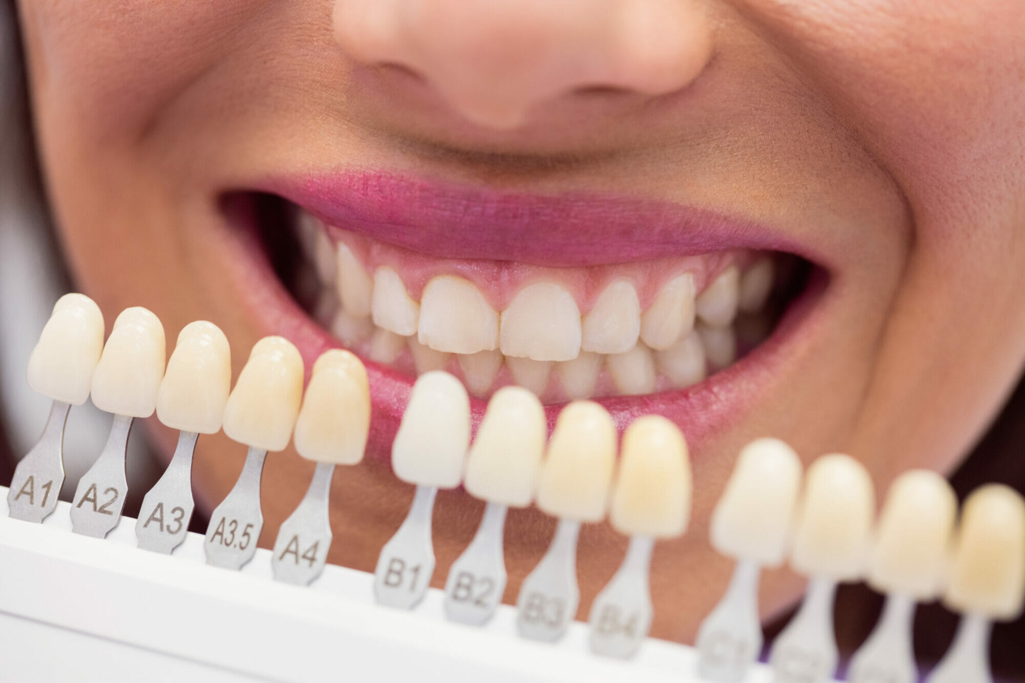Benefits of Professional Tooth Whitening